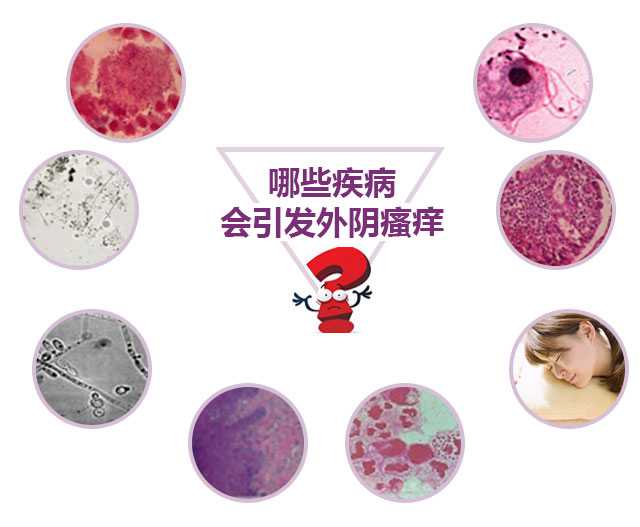 临床数据证实 10个外阴瘙痒女性中有6个同时存在以下症状: 科学检查
